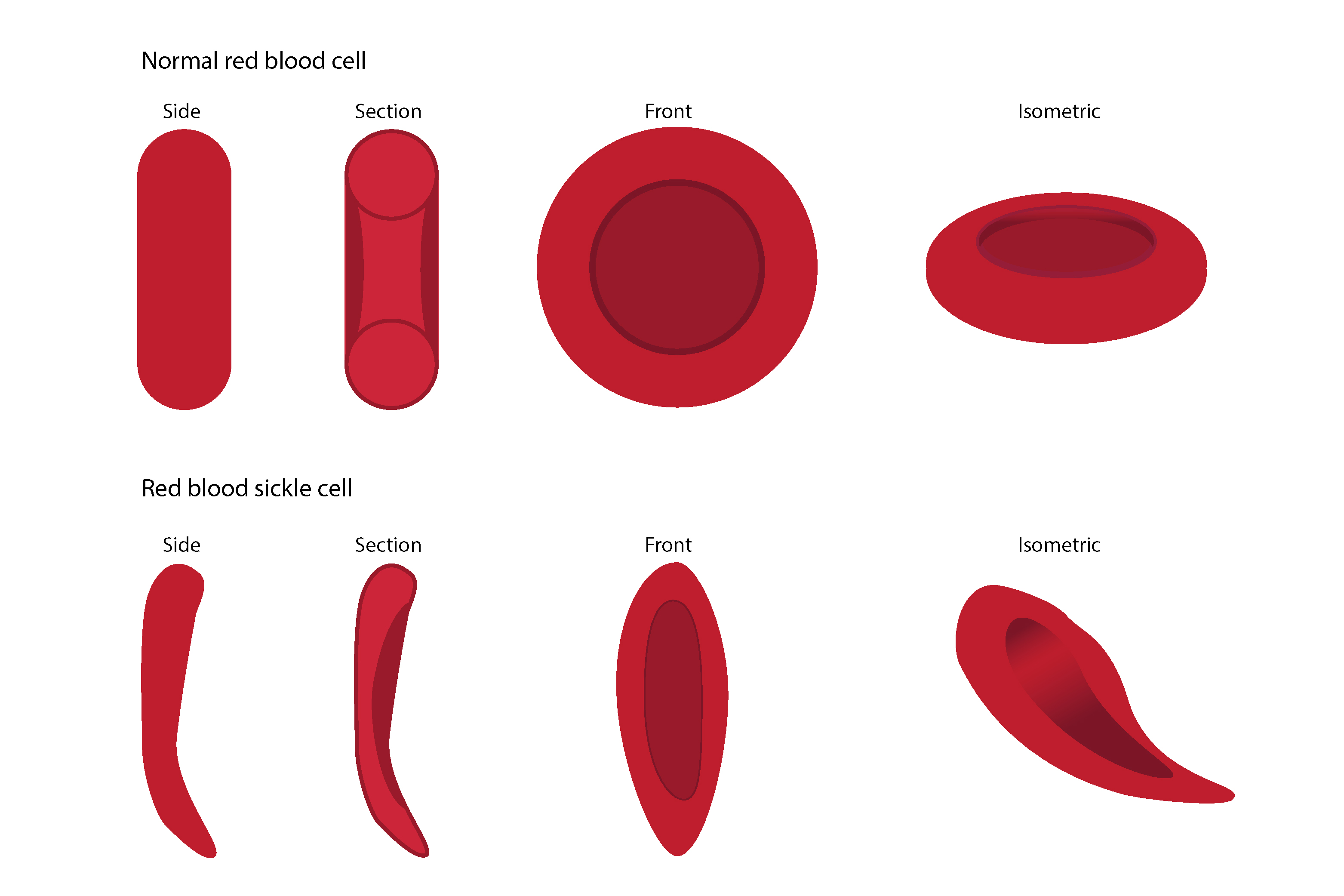 Front, cross side and isometric veiws of the difference between normal red blood cells and deformed sickle cells, showing how they struggle to carry oxygen normally